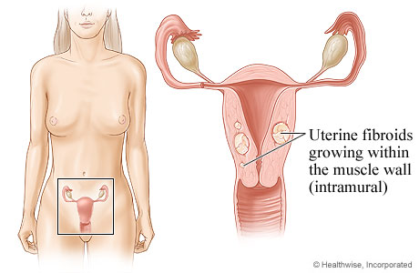 Location of uterus and ovaries, with detail of fibroid growing in uterine wall