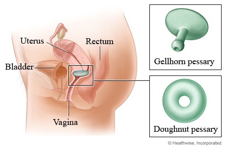 Gellhorn and doughnut pessaries