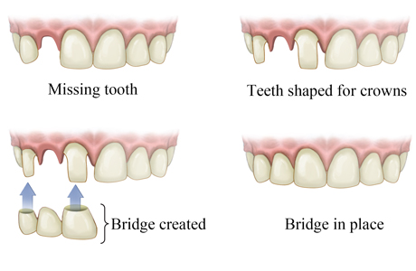 How a bridge is put in for a missing tooth