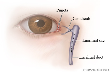 Causes Blocked Tear Ducts Adults With Braces Causes Blocked Tear Ducts Adults With Braces