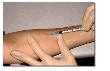 Mantoux tuberculin skin test 